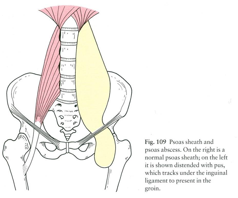psoas-abscess psoas-abscess